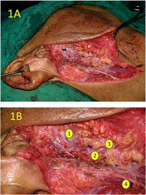 Parotid Quadrantectomy Is a Safe Management for Localized Pleomorphic Adenoma